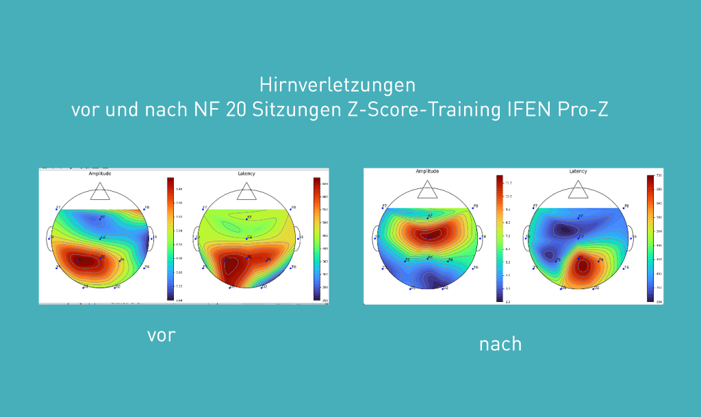Brainmaps von Hirnverletzungen vor und nach NF 20 Sitzungen Z-Score-Training IFEN Pro-Z